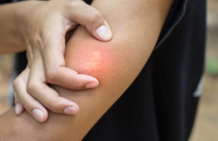How Do You Treat An Insect Sting While Camping? How Do You Treat An Insect Sting While Camping?