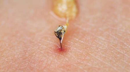 How Do You Treat An Insect Sting While Camping?